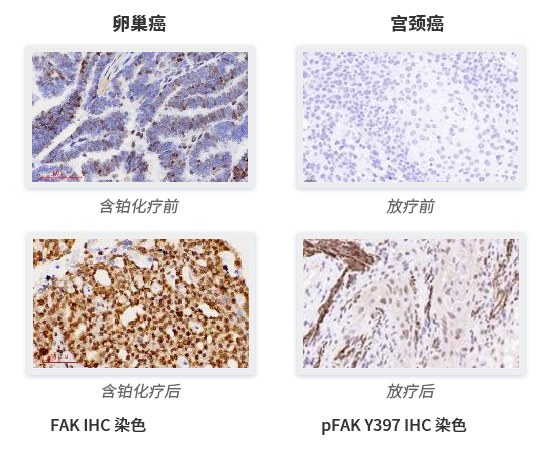 Targeting Key Signaling Hub of Tumor Defens