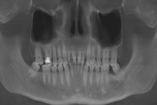 前牙早期種植